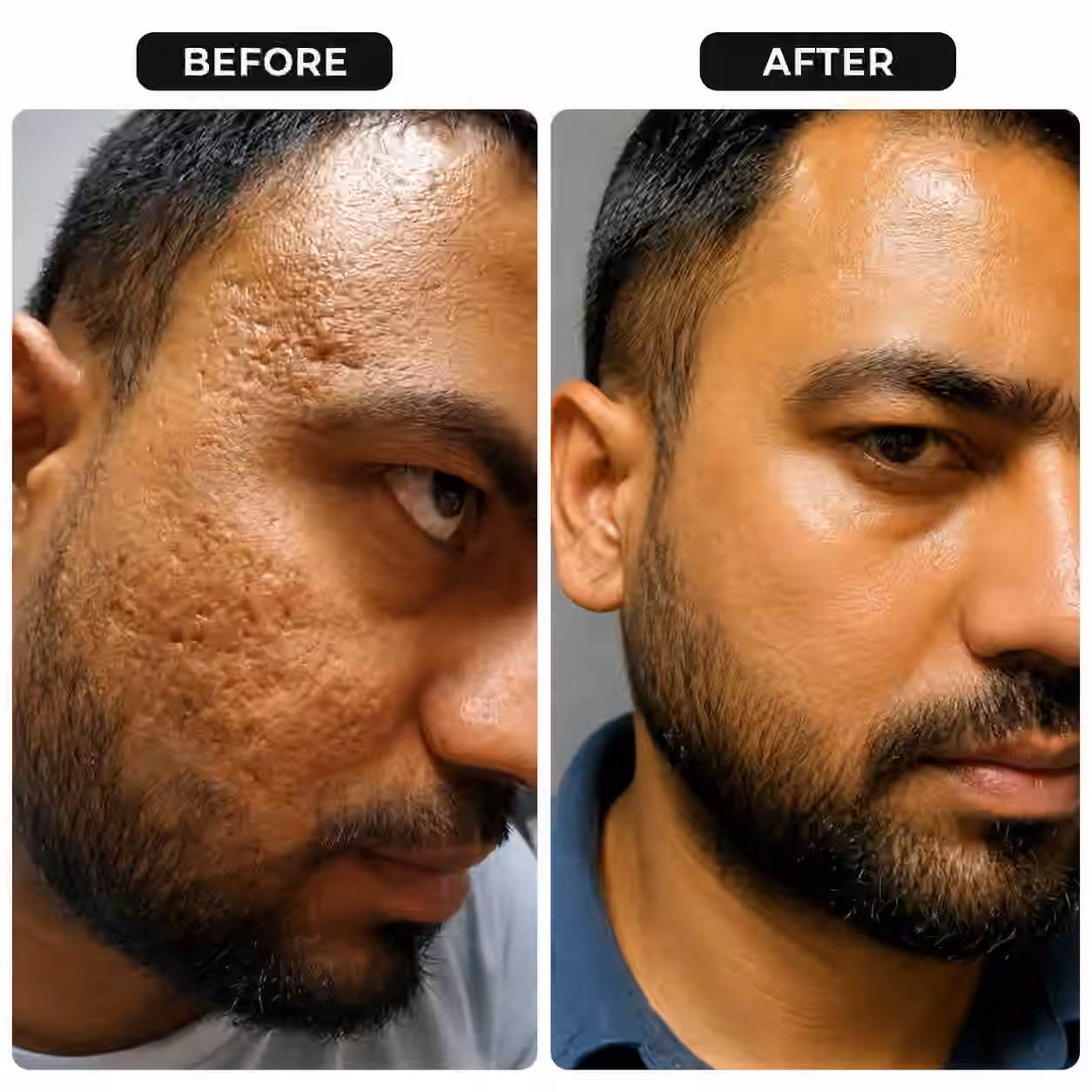 zurie_acne_scar_1254x1254_q15 zurie_acne_scar_1254x1254_q15