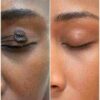 Birthmark & Dark Spot Care Treatment