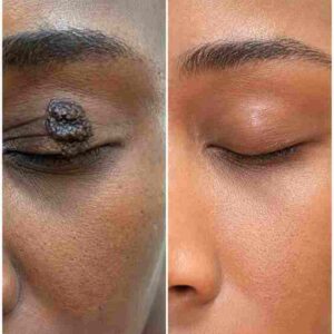Birthmark & Dark Spot Care Treatment