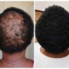 Hair Growth & Scalp Nourishing Treatment