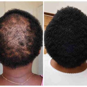 Hair Growth & Scalp Nourishing Treatment