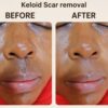 Keloid & Scar Care Treatment Cream