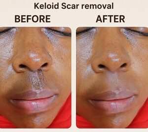 Keloid & Scar Care Treatment Cream