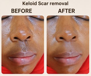 Keloid & Scar Care Treatment Cream