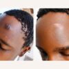 Skin Revision Keloid & Scar Care Cream