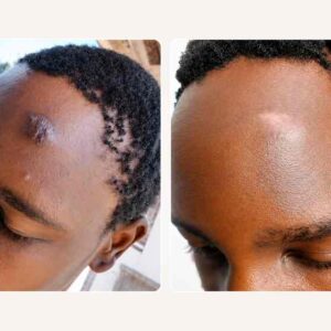 Skin Revision Keloid & Scar Care Cream
