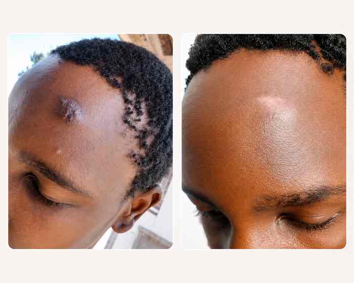 Skin Revision Keloid & Scar Care Cream
