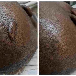 Skin Revision Scar Care Treatment