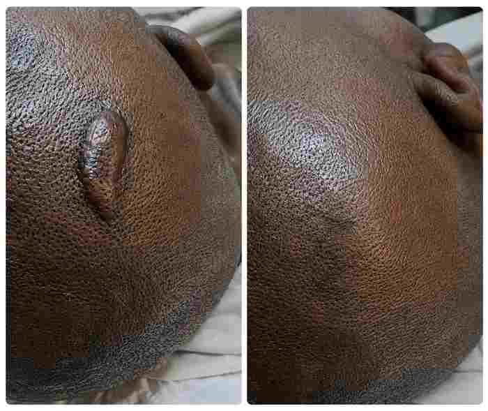 Skin Revision Scar Care Treatment