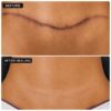 Skin Revision Surgical Scar Care Treatment