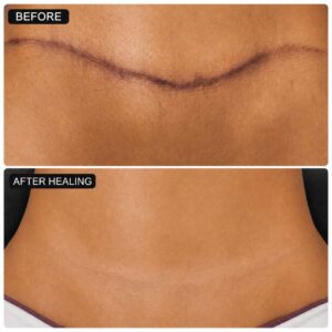 Skin Revision Surgical Scar Care Treatment