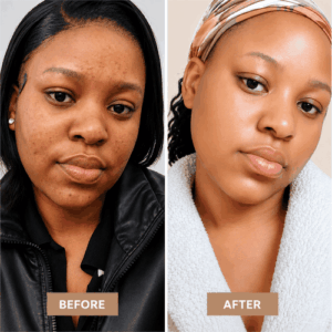 ZURIÉ Clear Skin Cream – Dark Mark & Even Tone Care