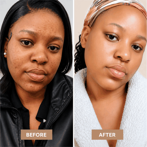 ZURIÉ Clear Skin Cream – Dark Mark & Even Tone Care